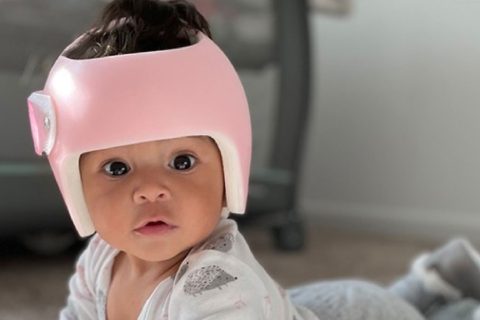 Cranial Helmet Therapy For Infants